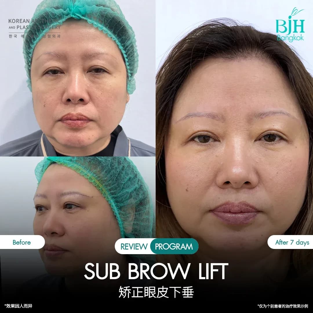 รีวิว Subbrowlift 01