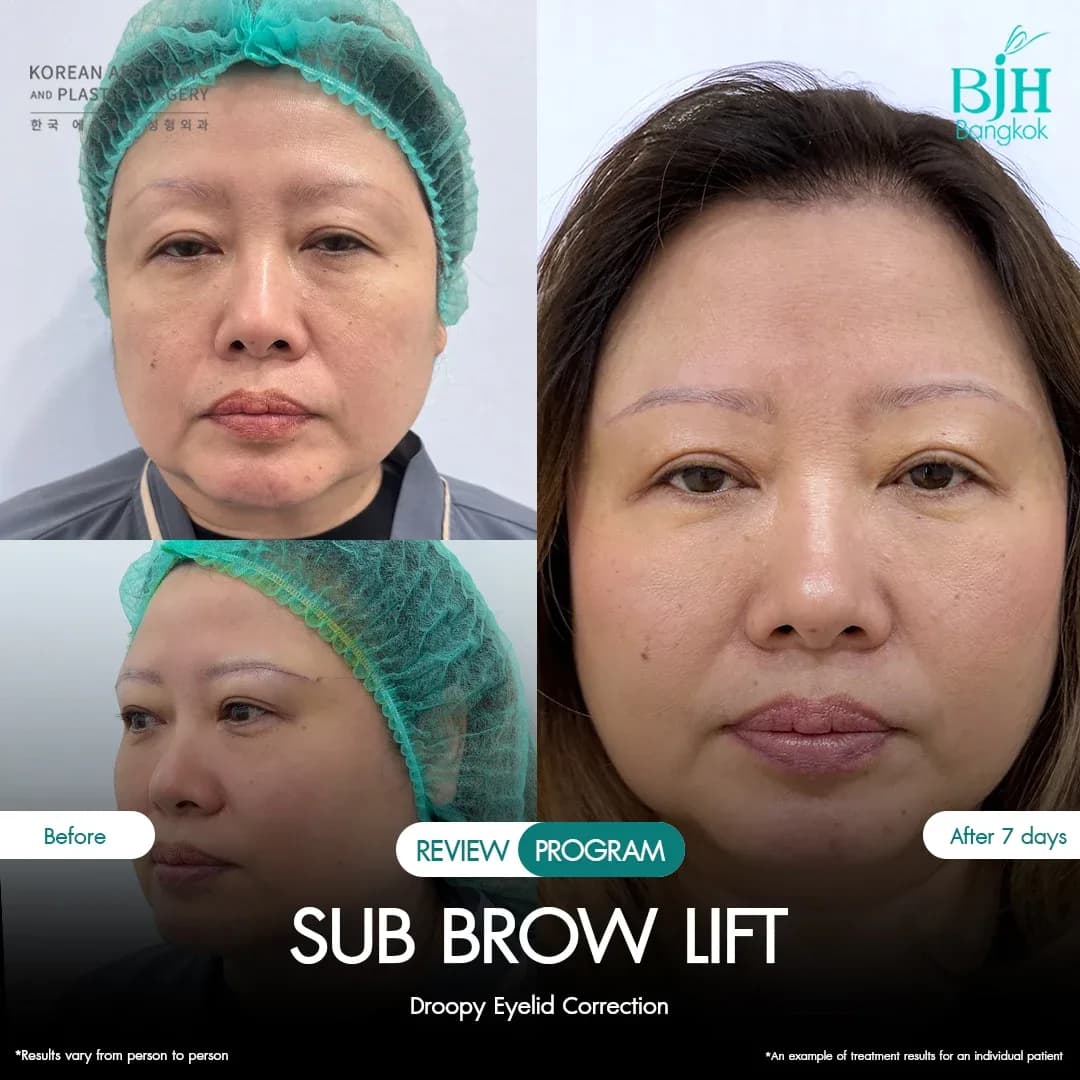 รีวิว Subbrowlift 01
