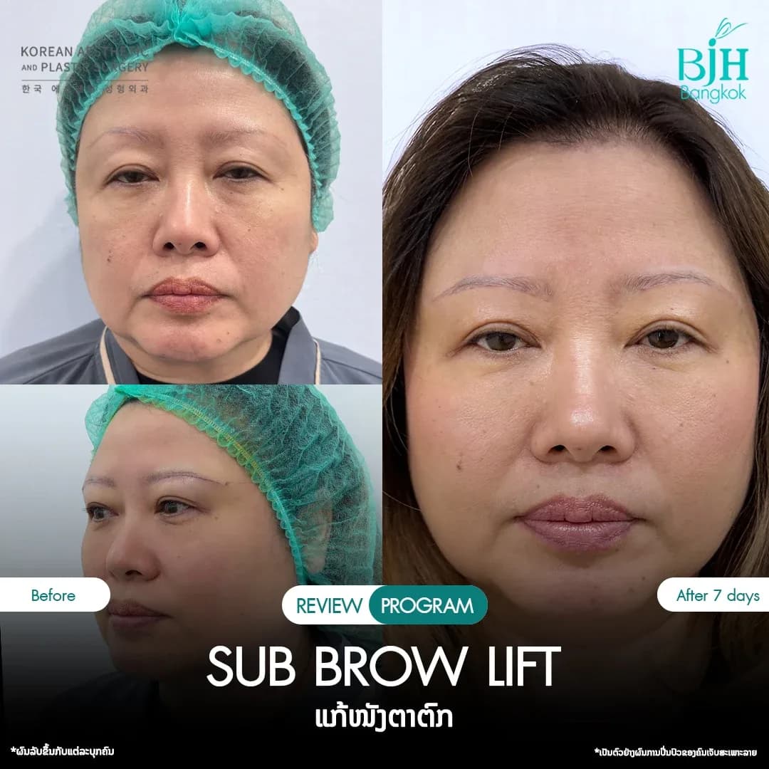 รีวิว Subbrowlift 01