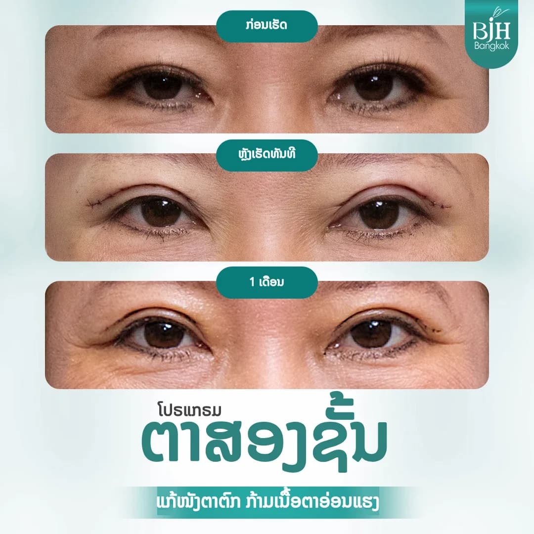 ตาสองชั้น 03