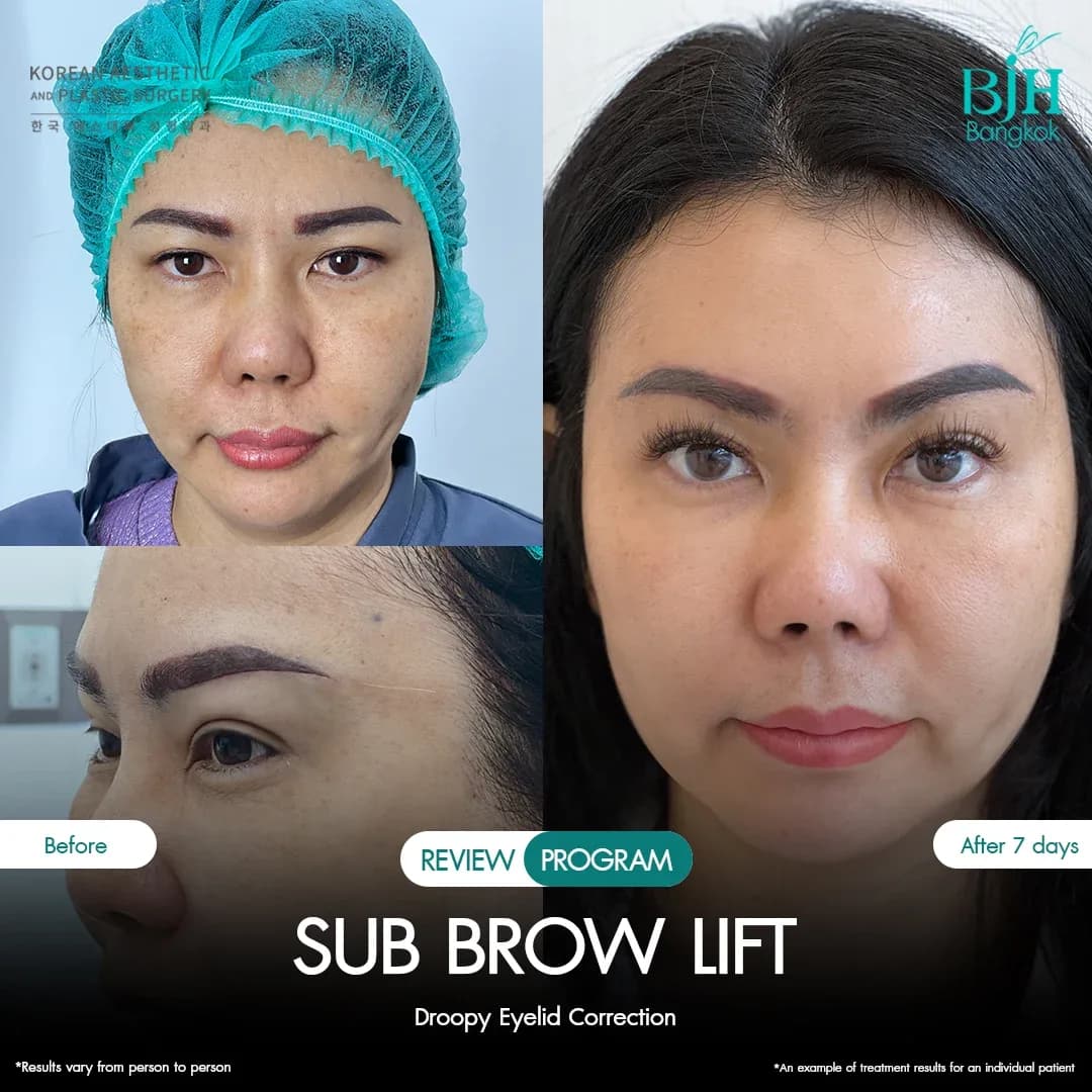 รีวิว Subbrowlift 04