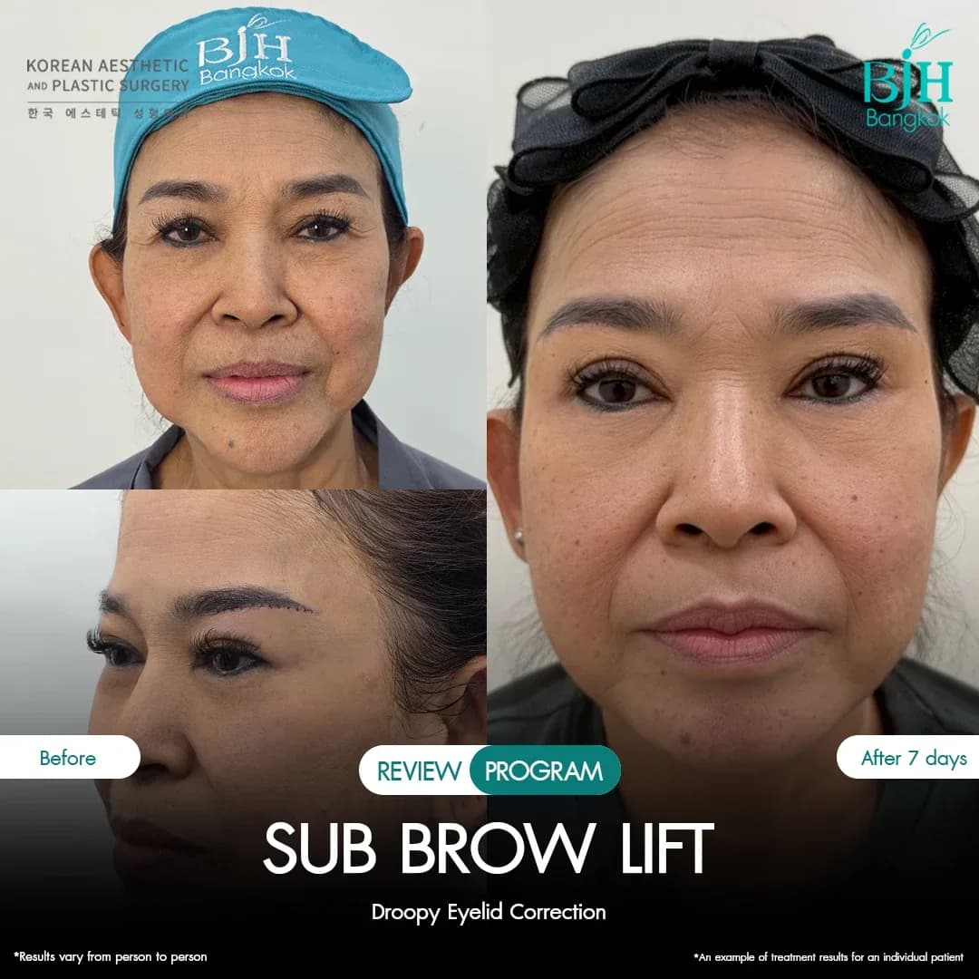 รีวิว Subbrowlift 07