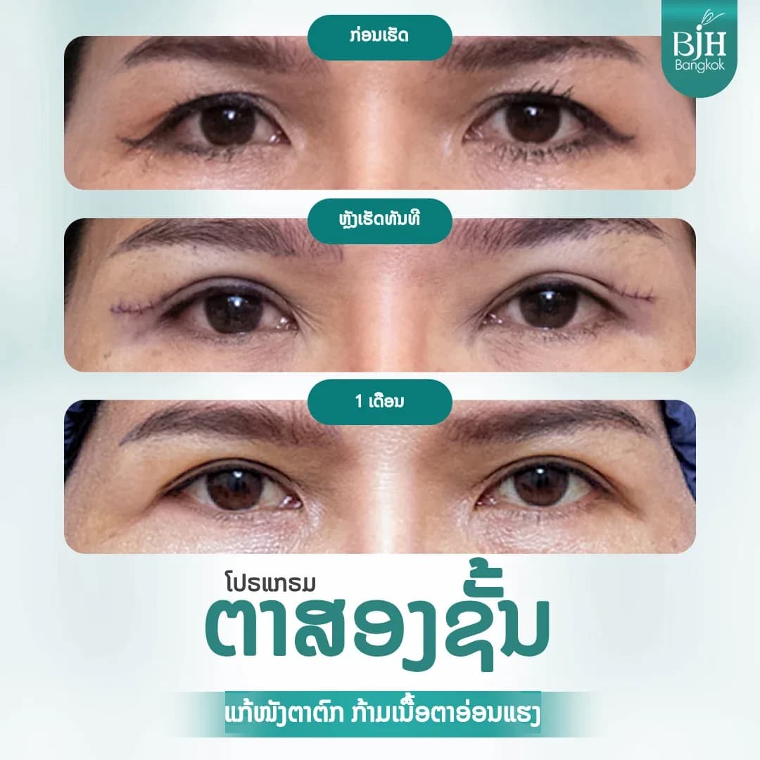 ตาสองชั้น 04
