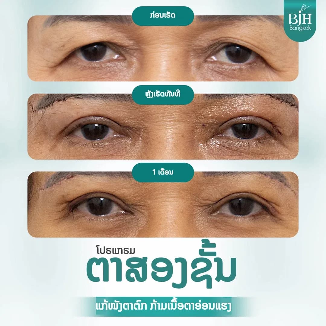 ตาสองชั้น 01