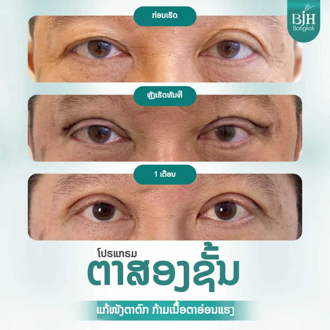 ตาสองชั้น 10