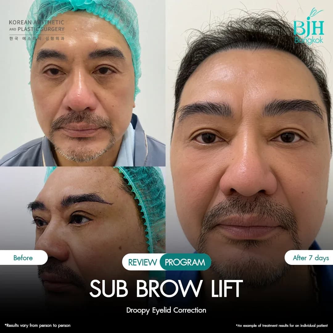 รีวิว Subbrowlift 03