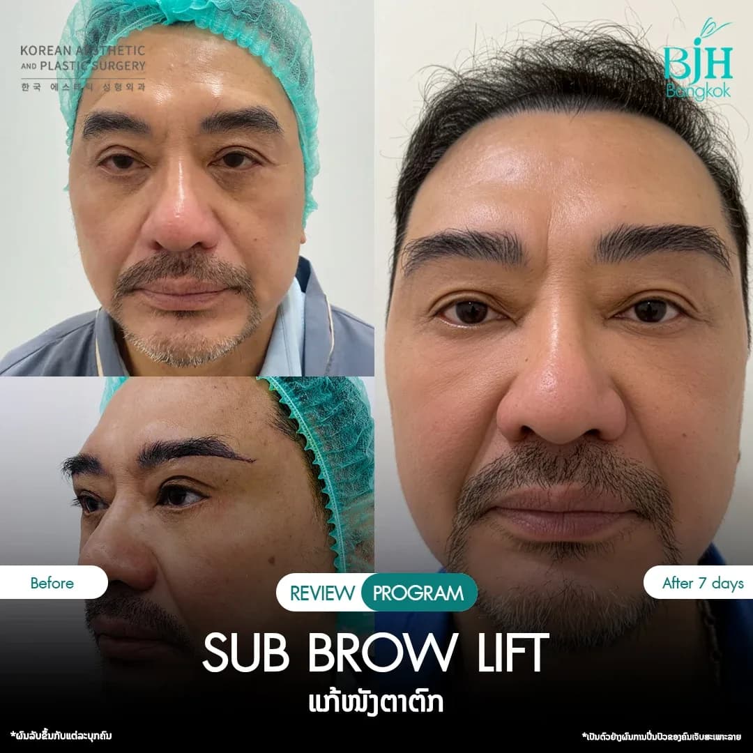 รีวิว Subbrowlift 03