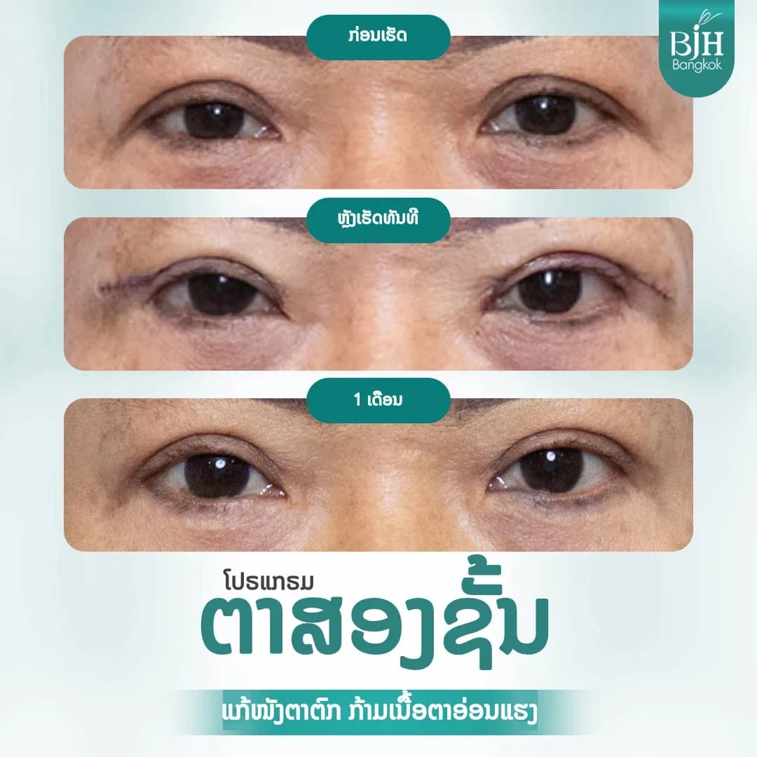 ตาสองชั้น 05