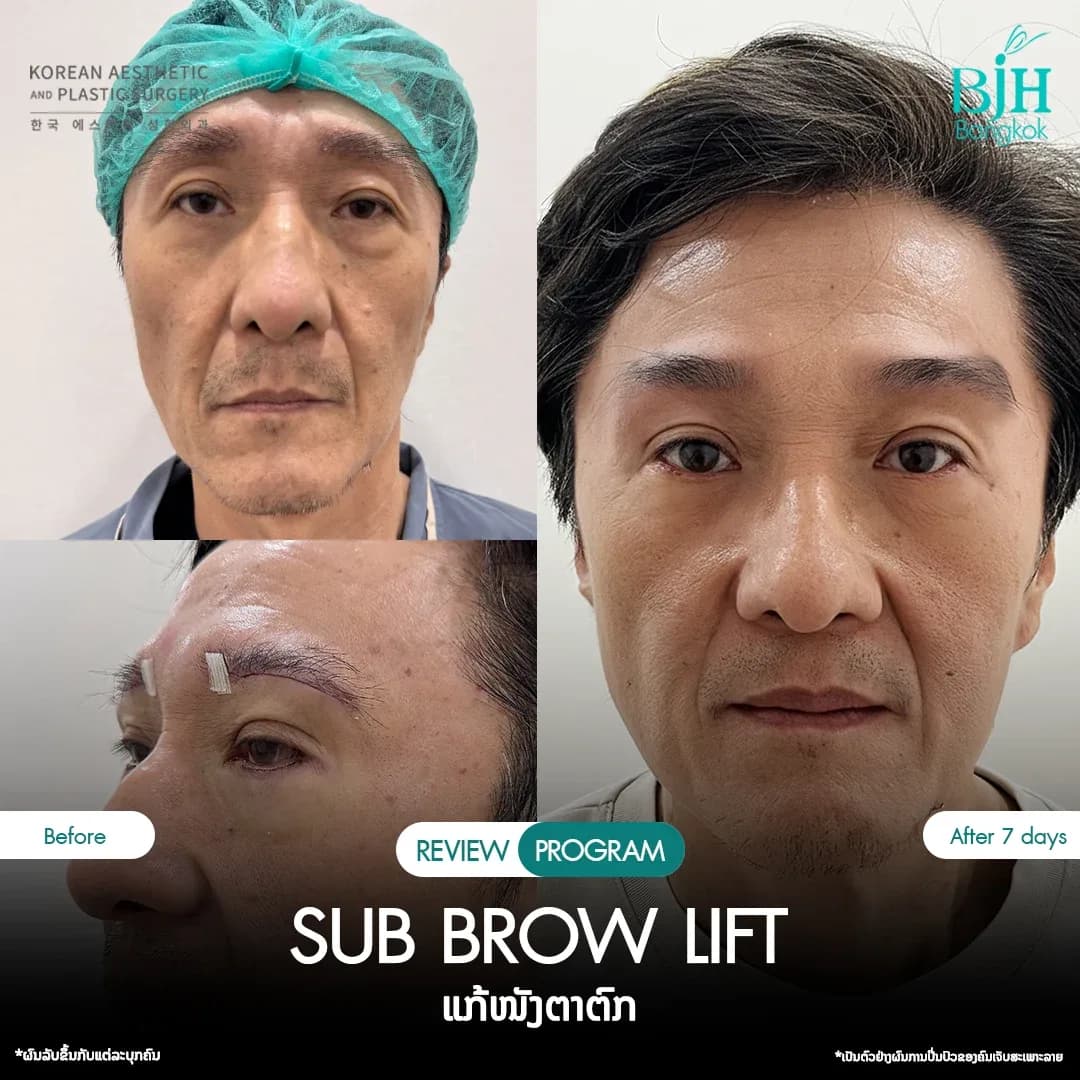 รีวิว Subbrowlift 05