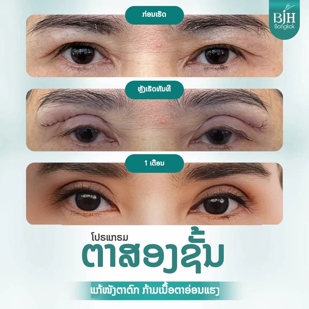 ตาสองชั้น 08