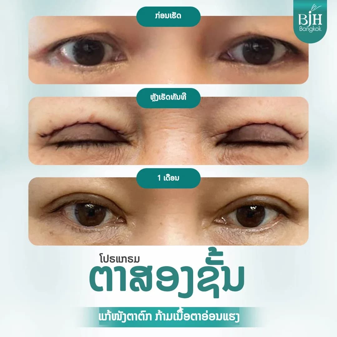 ตาสองชั้น 11