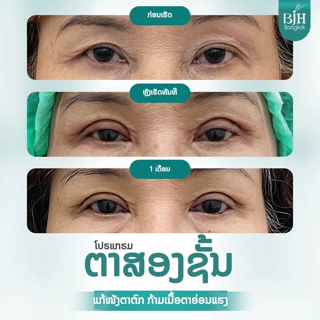 ตาสองชั้น 14