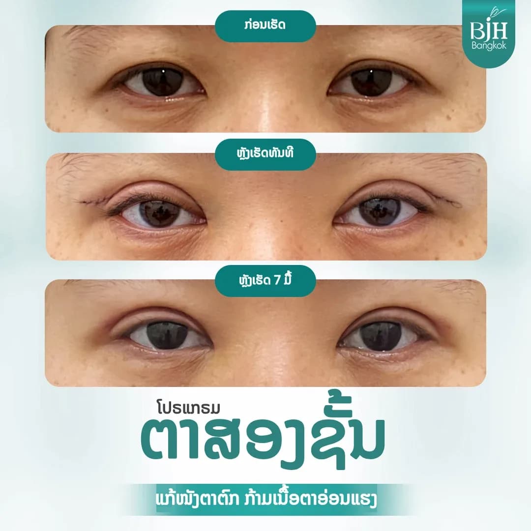 ตาสองชั้น 17
