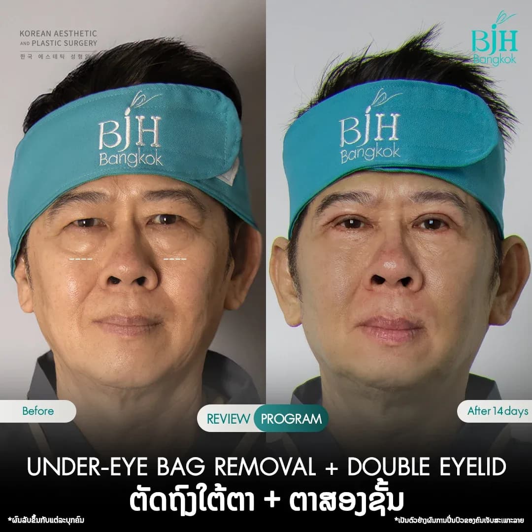 ตัดถุงใต้ตา2