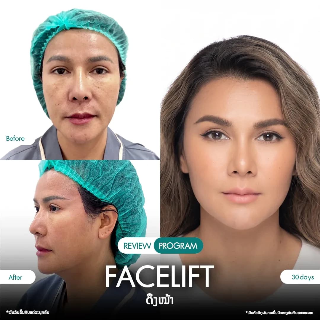 รีวิวดึงหน้า 10