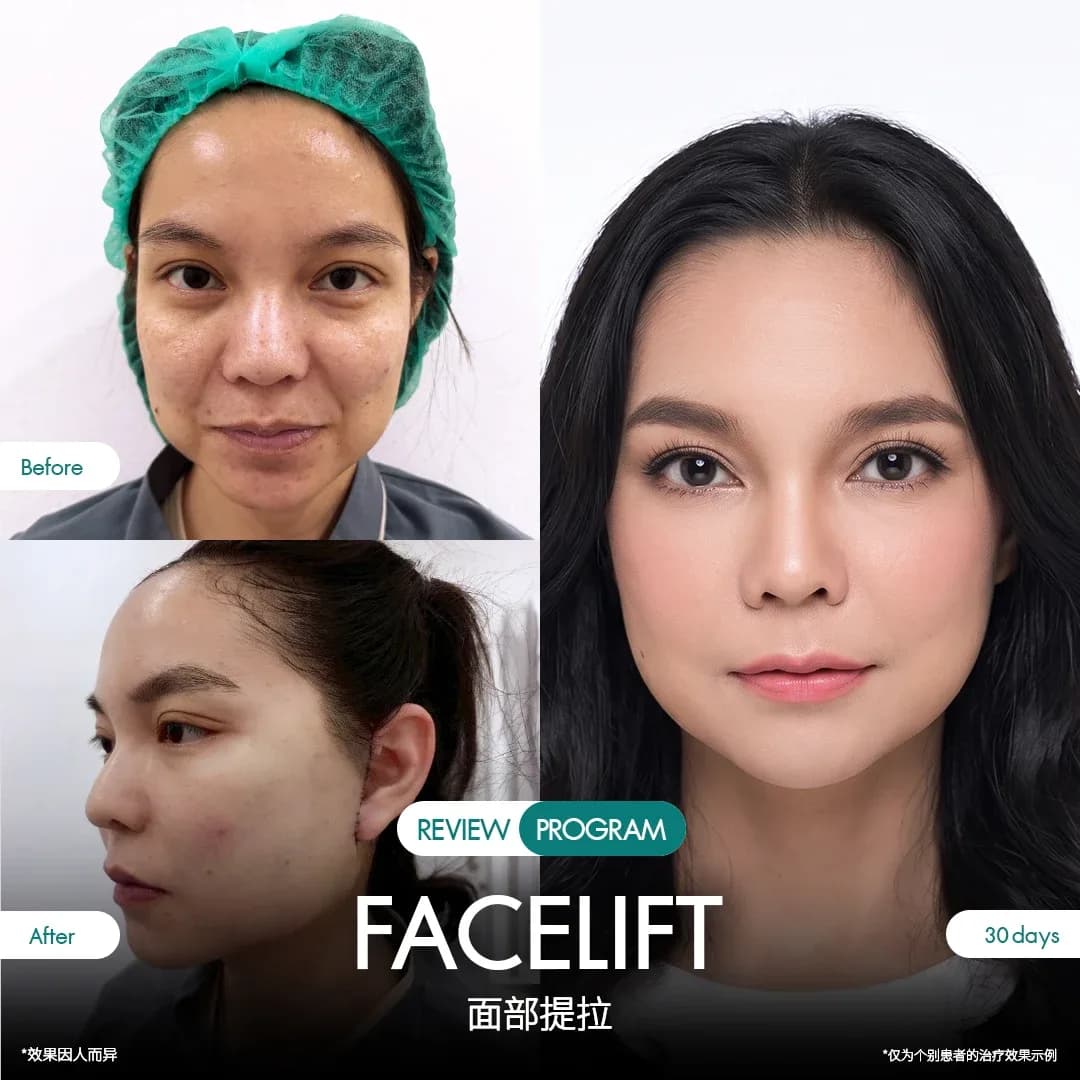 รีวิวดึงหน้า 15