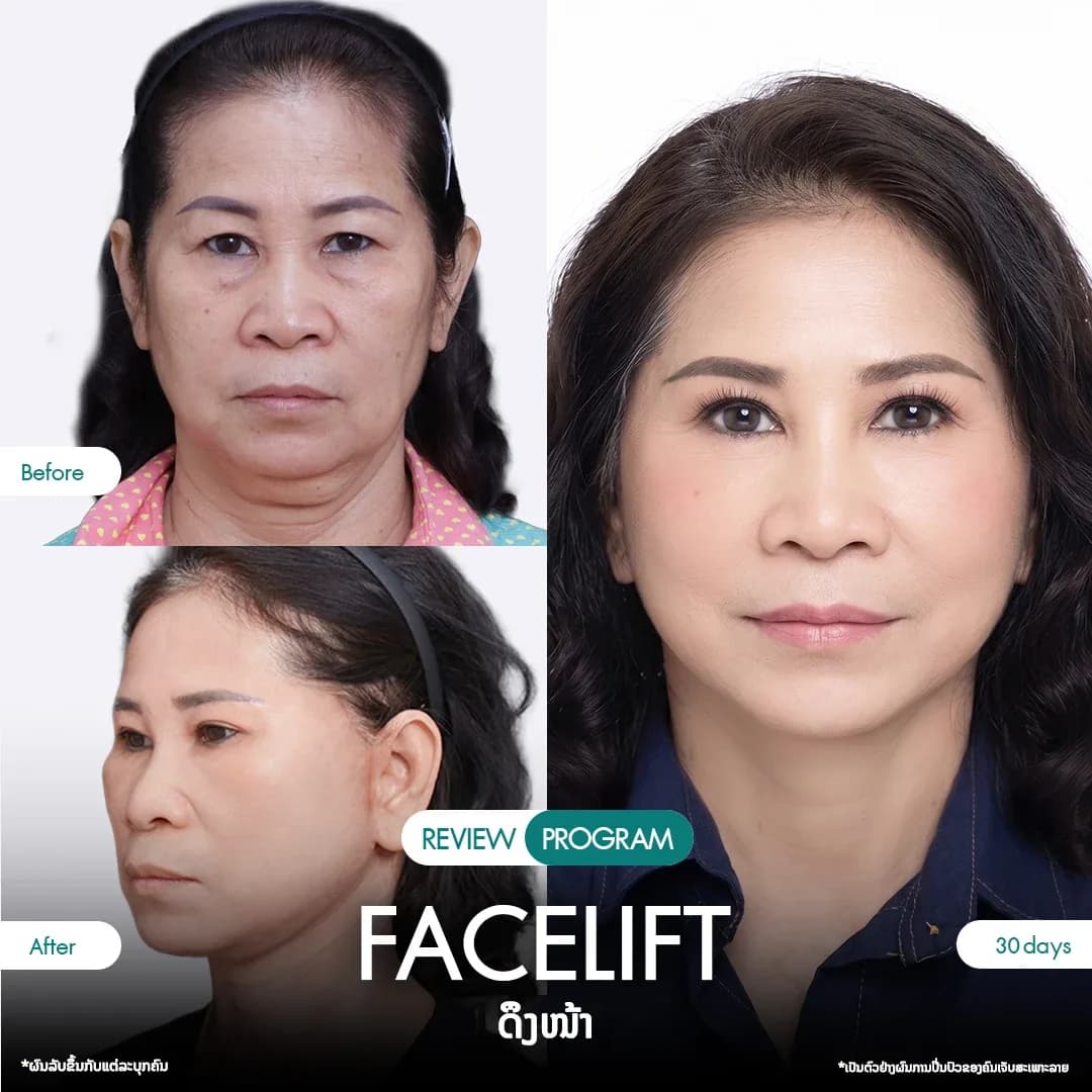 รีวิวดึงหน้า 02