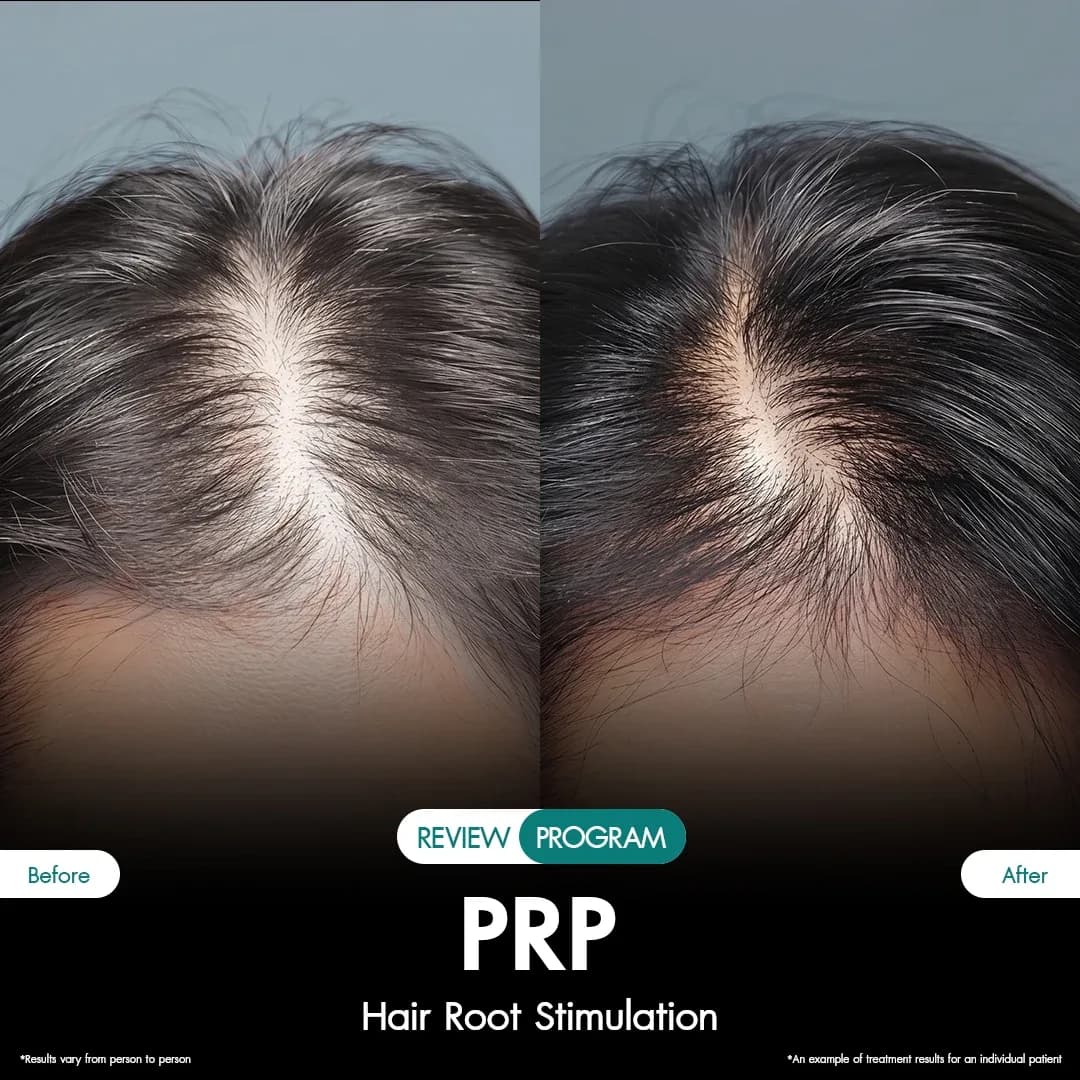 รีวิว ปลูกผม PRP 01