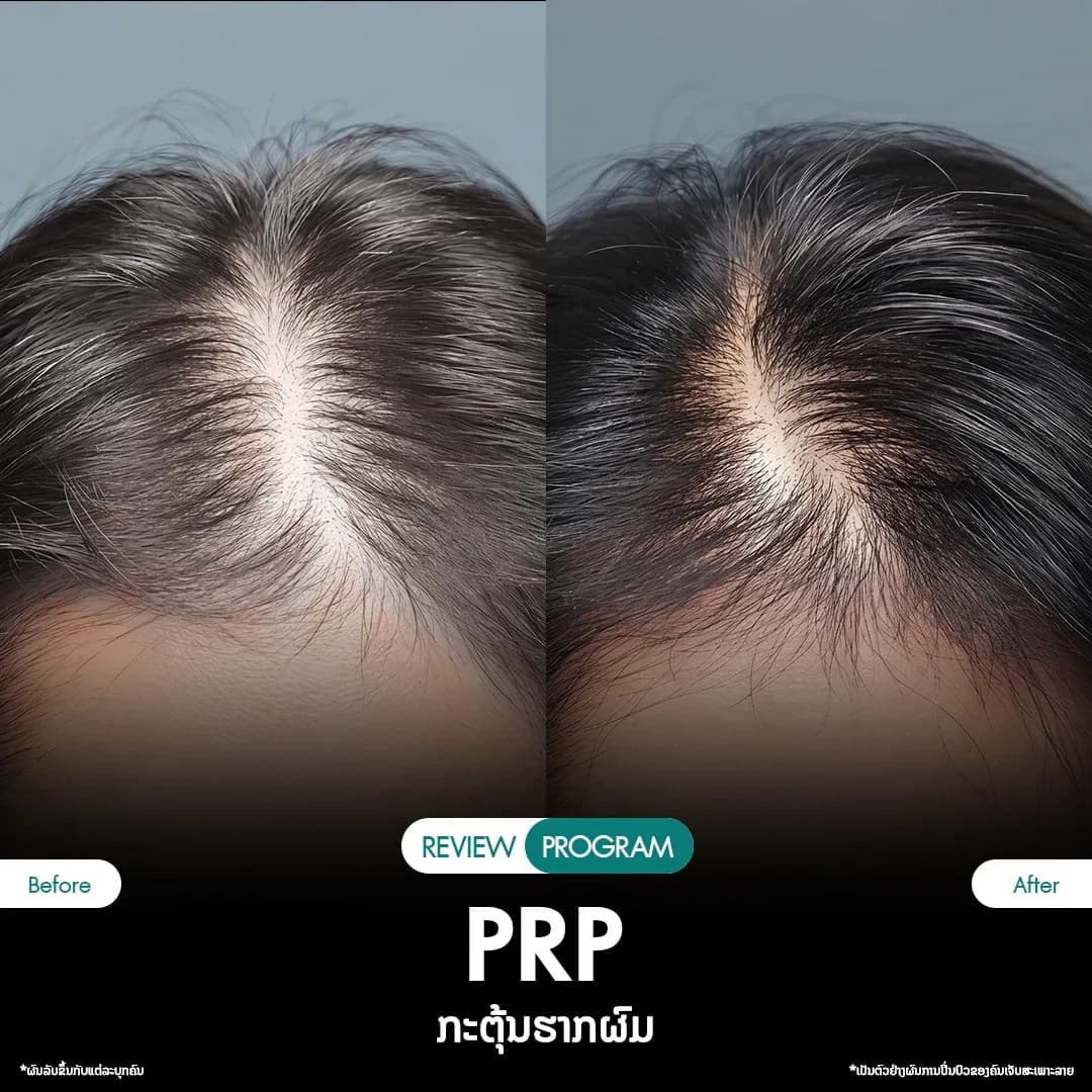 รีวิว ปลูกผม PRP 01