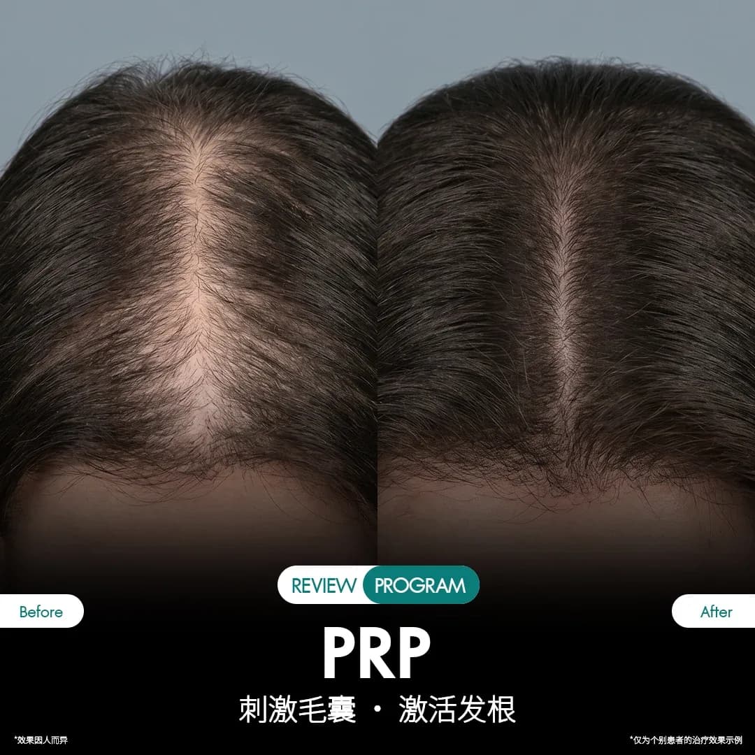 รีวิว ปลูกผม PRP 02
