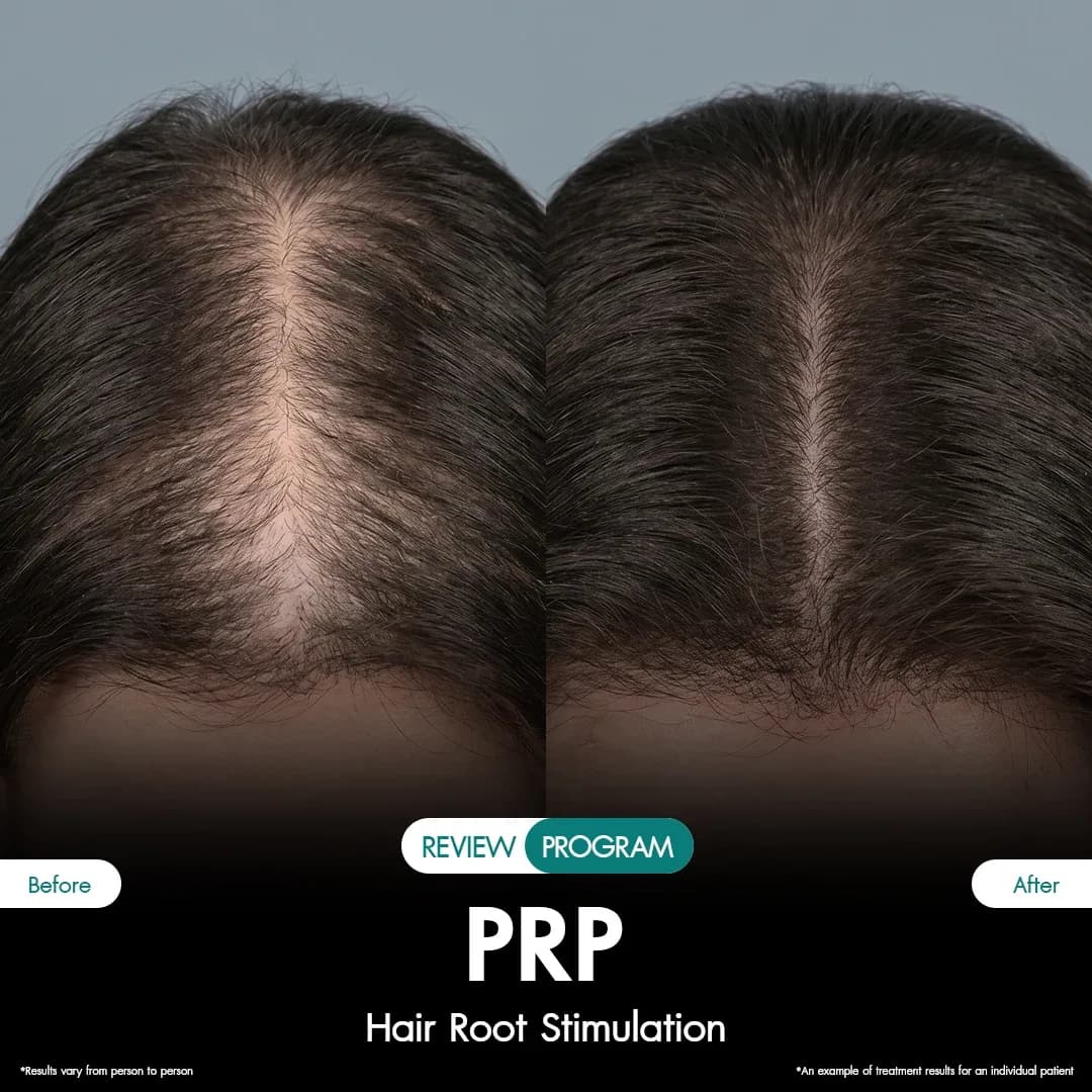 รีวิว ปลูกผม PRP 02