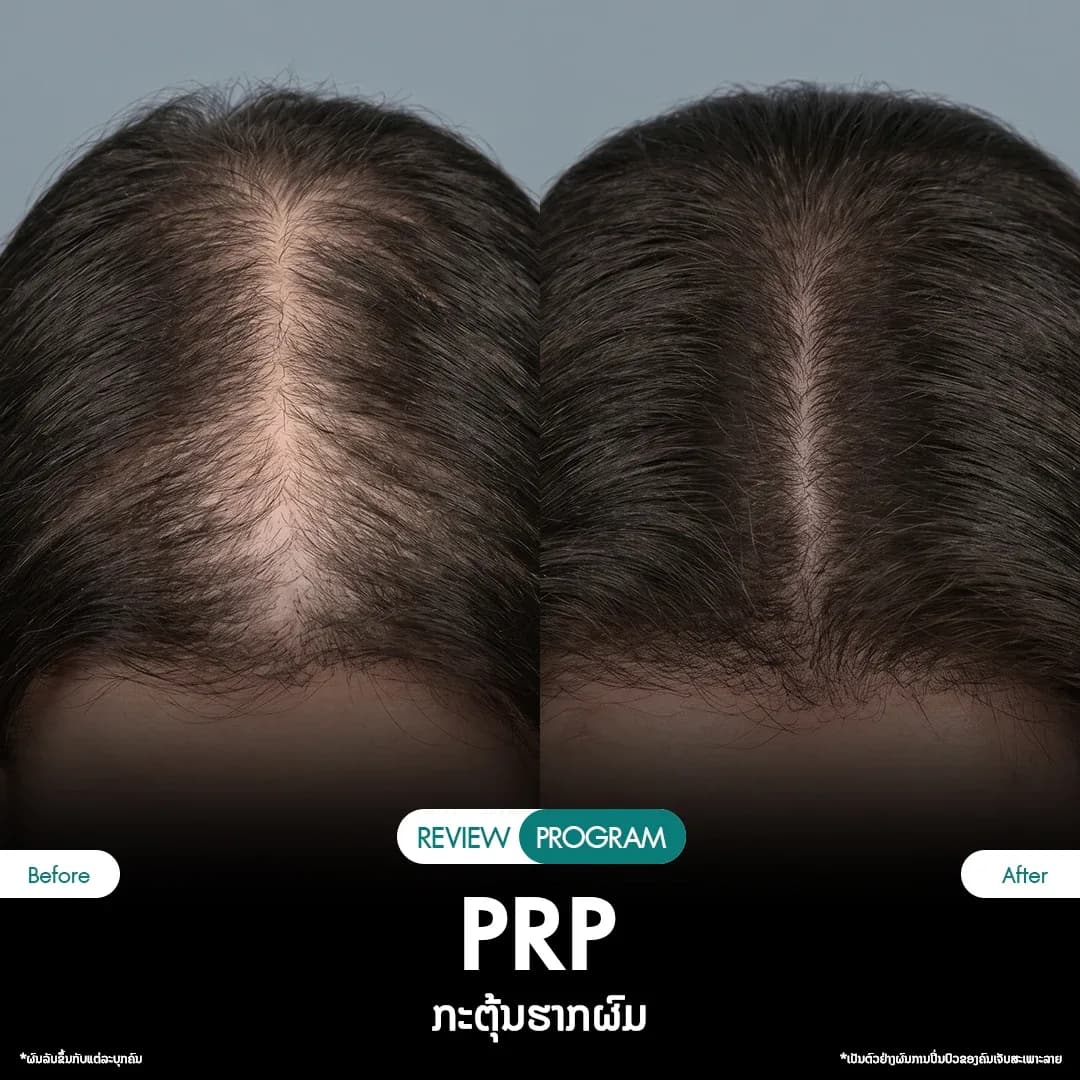 รีวิว ปลูกผม PRP 02