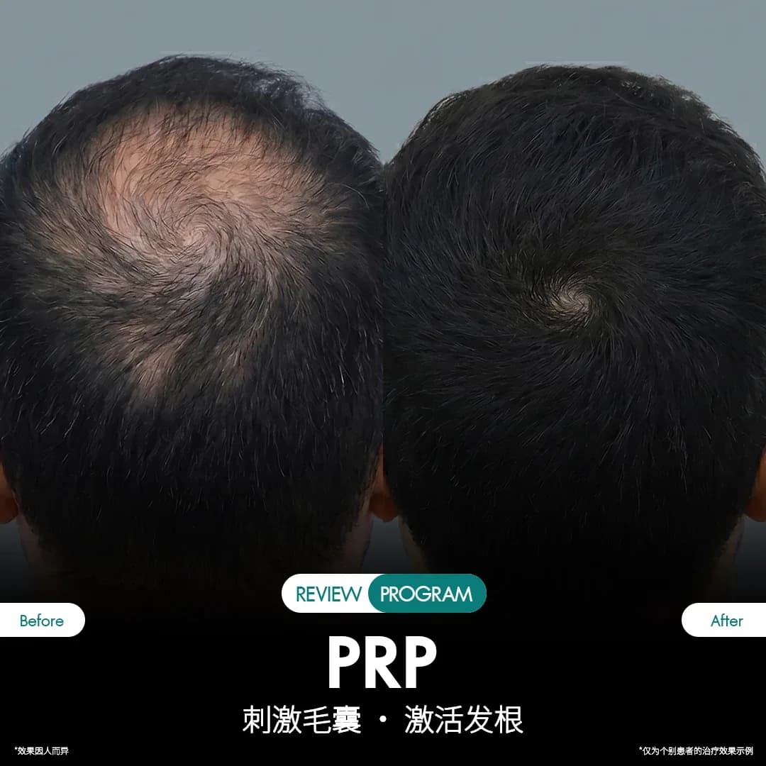 รีวิว ปลูกผม PRP 03