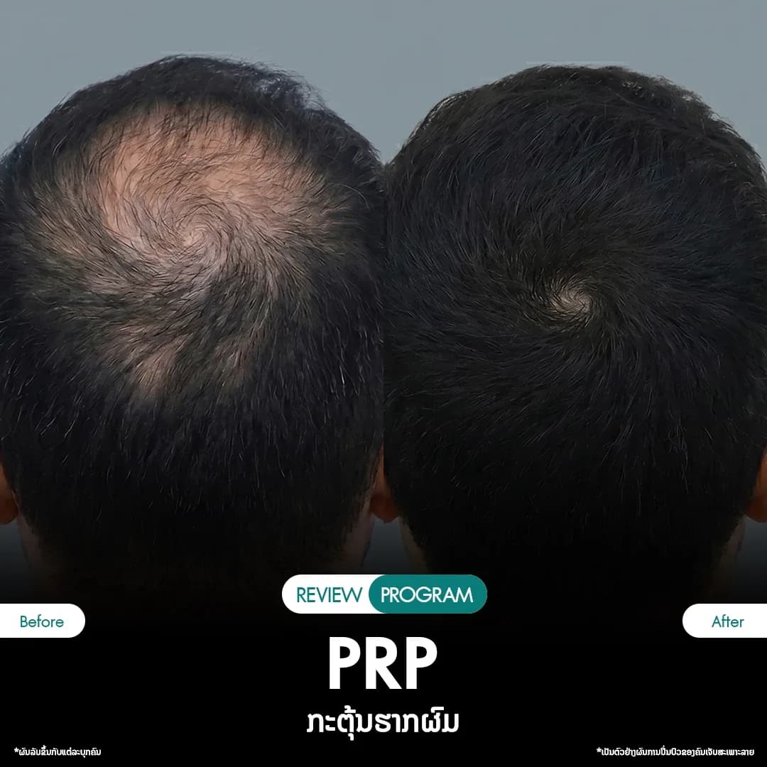 รีวิว ปลูกผม PRP 03