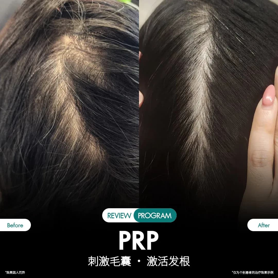 รีวิว ปลูกผม PRP 04