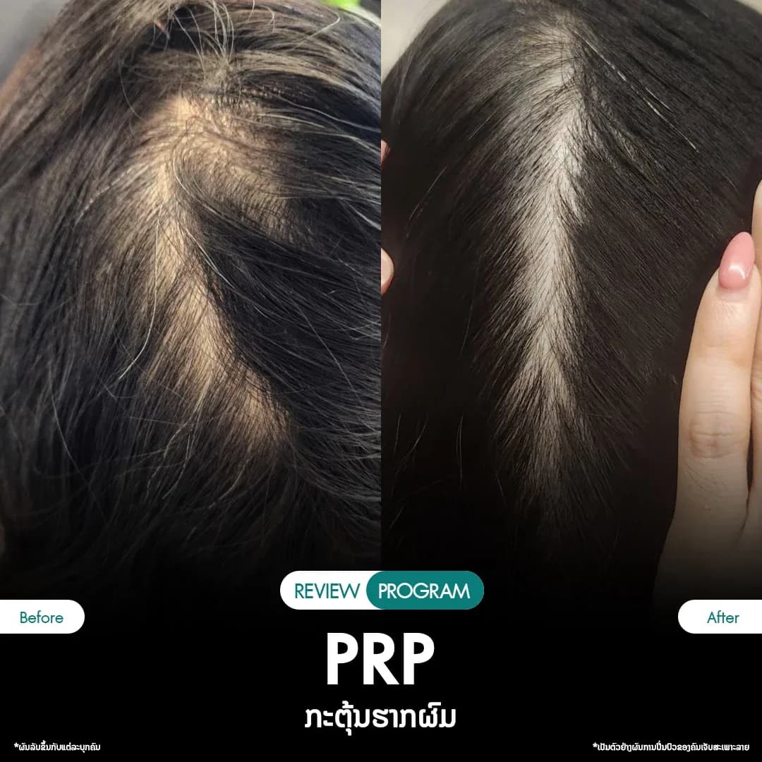 รีวิว ปลูกผม PRP 04