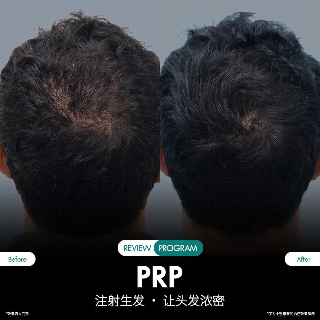 รีวิว ปลูกผม PRP 05