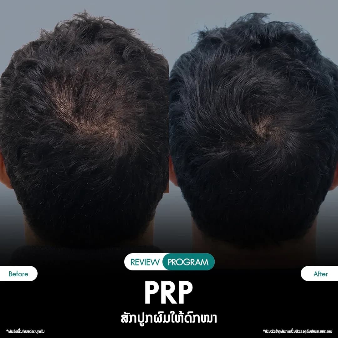 รีวิว ปลูกผม PRP 05