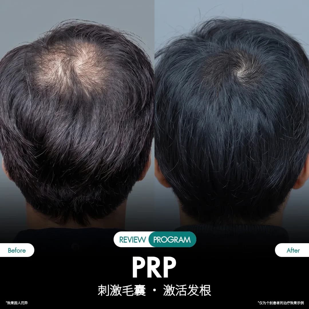 รีวิว ปลูกผม PRP 06