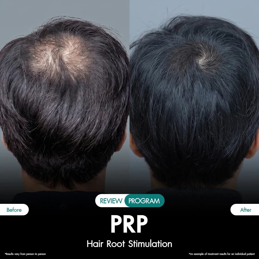 รีวิว ปลูกผม PRP 06
