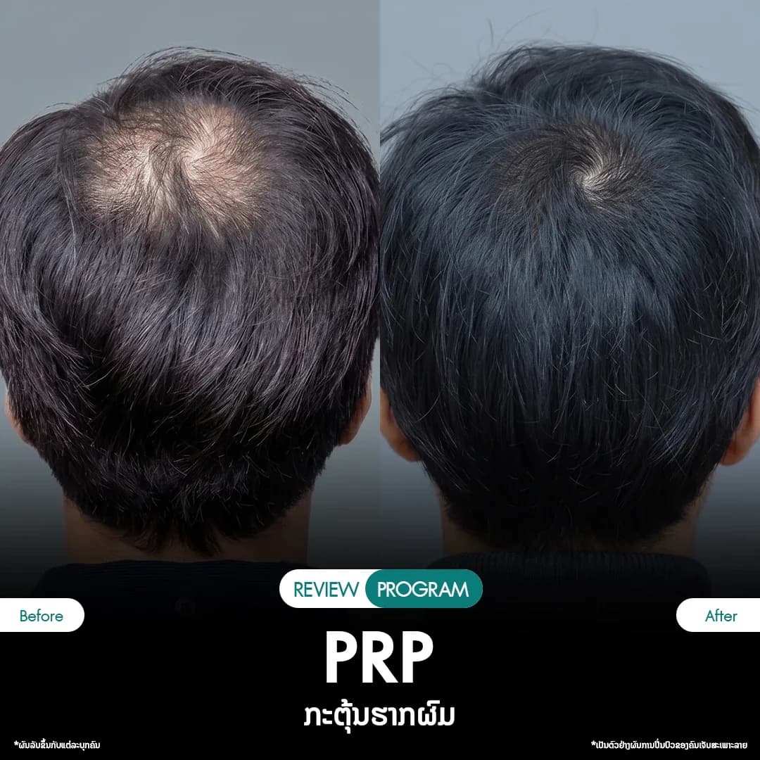 รีวิว ปลูกผม PRP 06