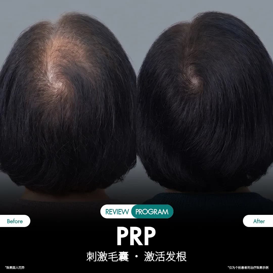 รีวิว ปลูกผม PRP 07