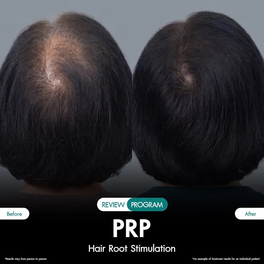 รีวิว ปลูกผม PRP 07
