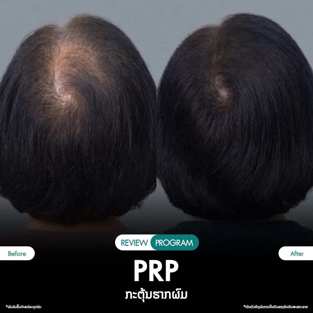 รีวิว ปลูกผม PRP 07