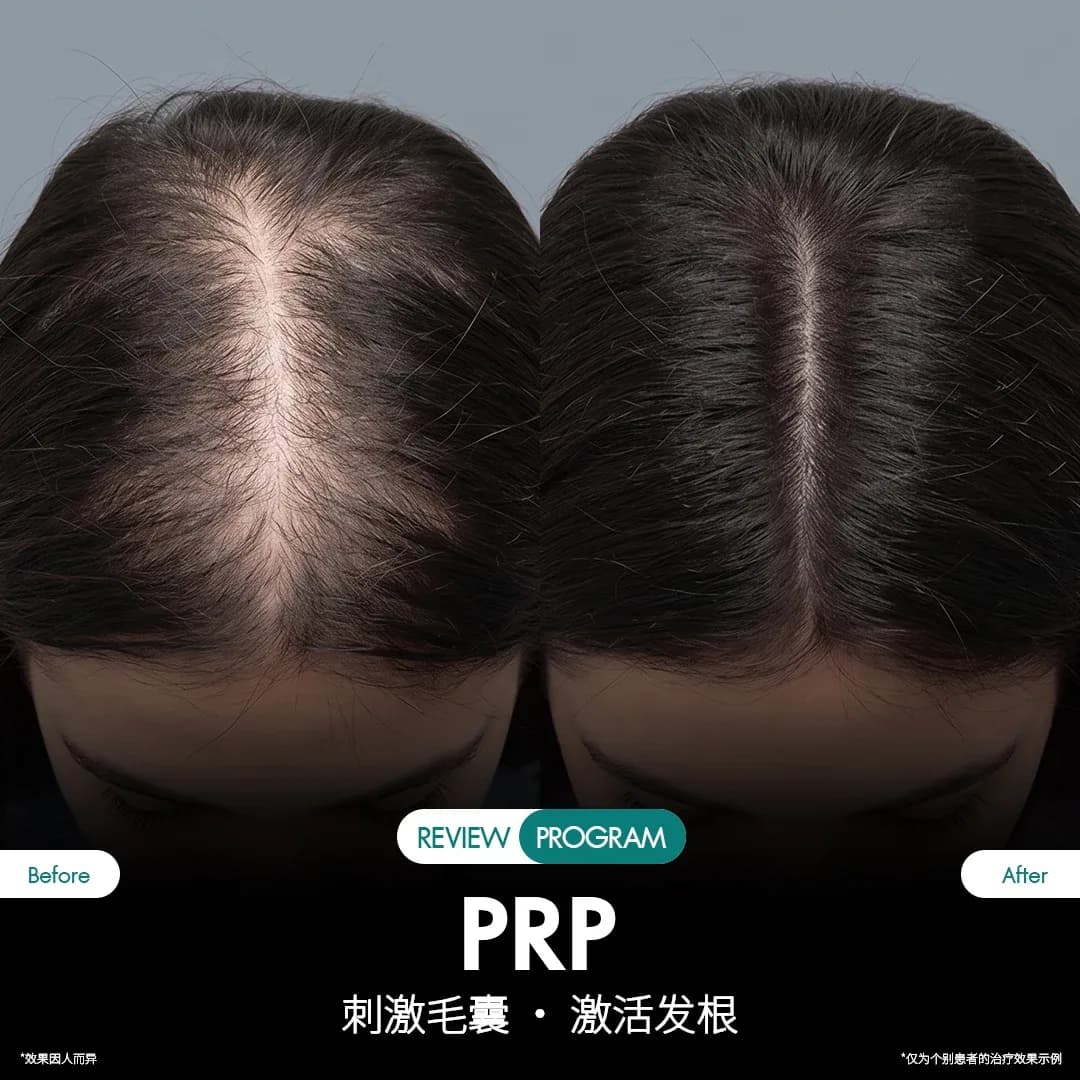 รีวิว ปลูกผม PRP 09