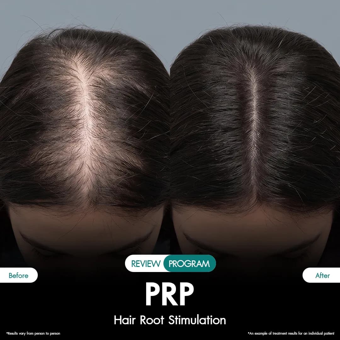 รีวิว ปลูกผม PRP 09