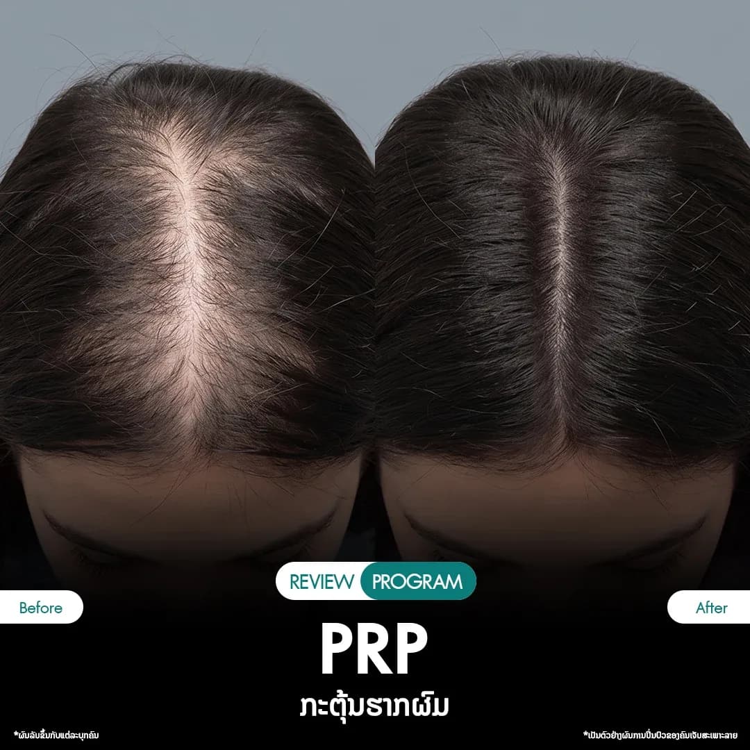 รีวิว ปลูกผม PRP 09