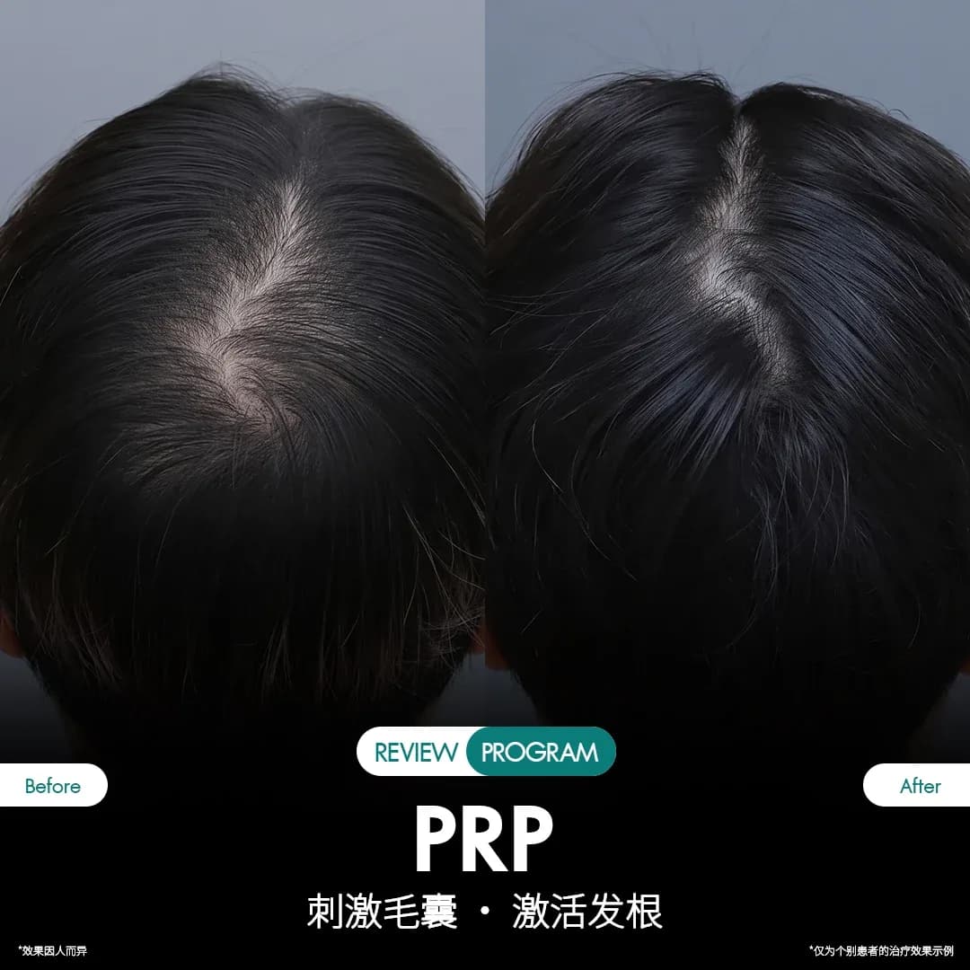 รีวิว ปลูกผม PRP 09
