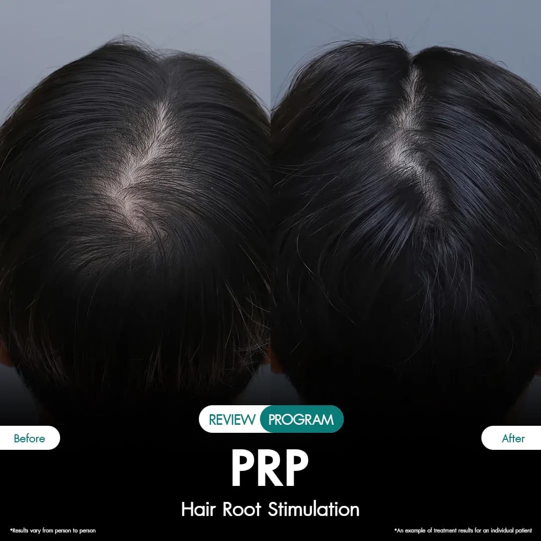 รีวิว ปลูกผม PRP 09