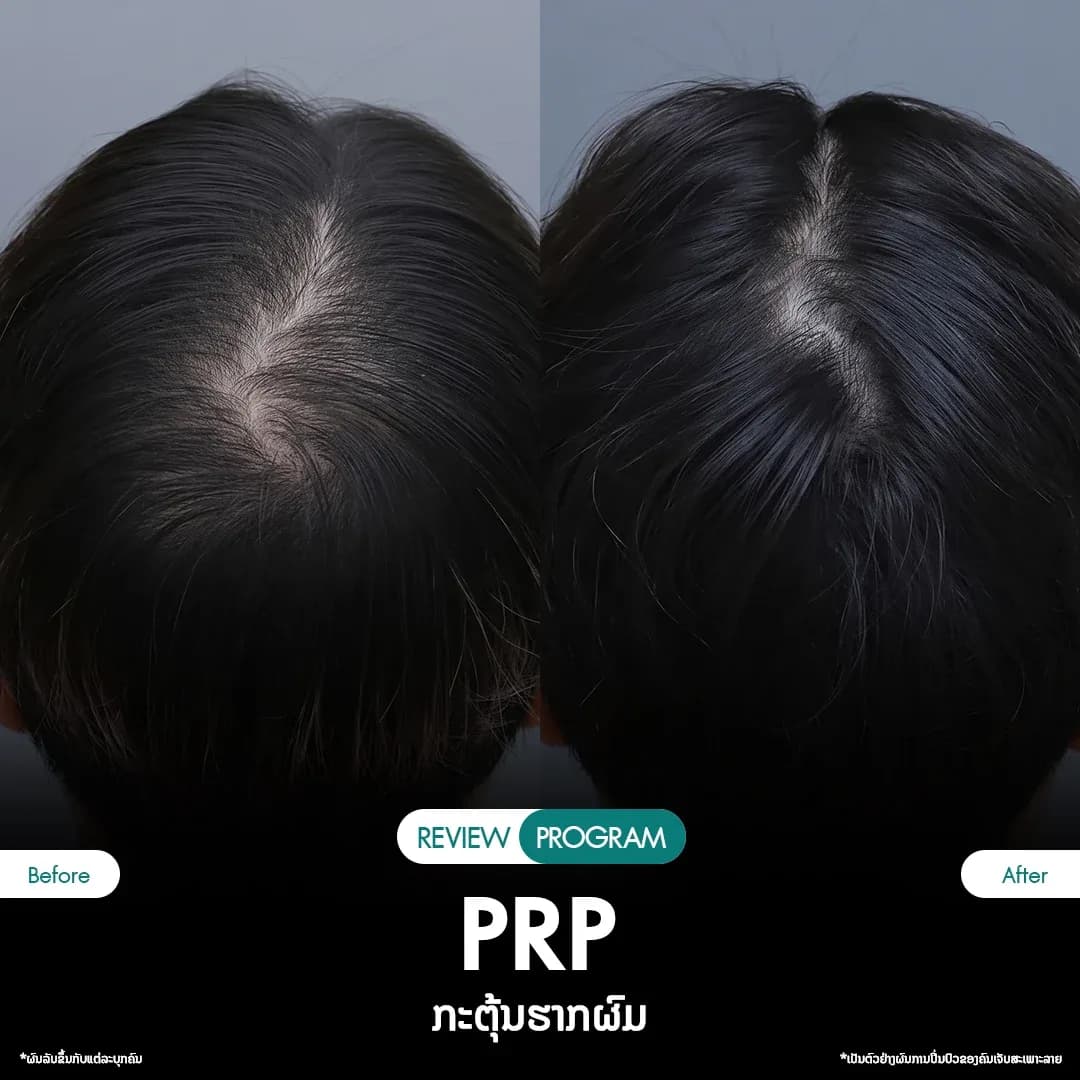 รีวิว ปลูกผม PRP 09