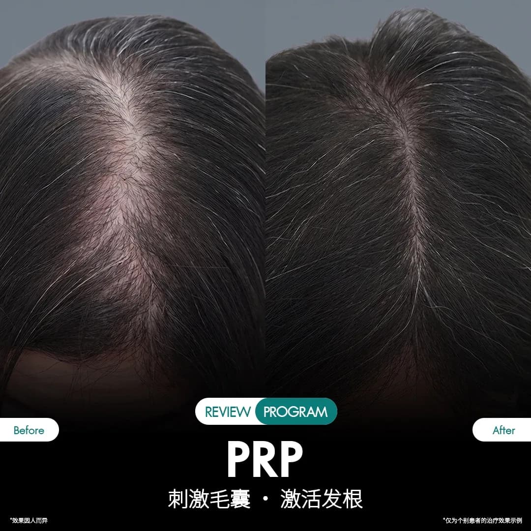 รีวิว ปลูกผม PRP 11