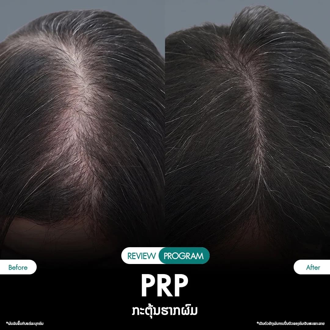 รีวิว ปลูกผม PRP 11