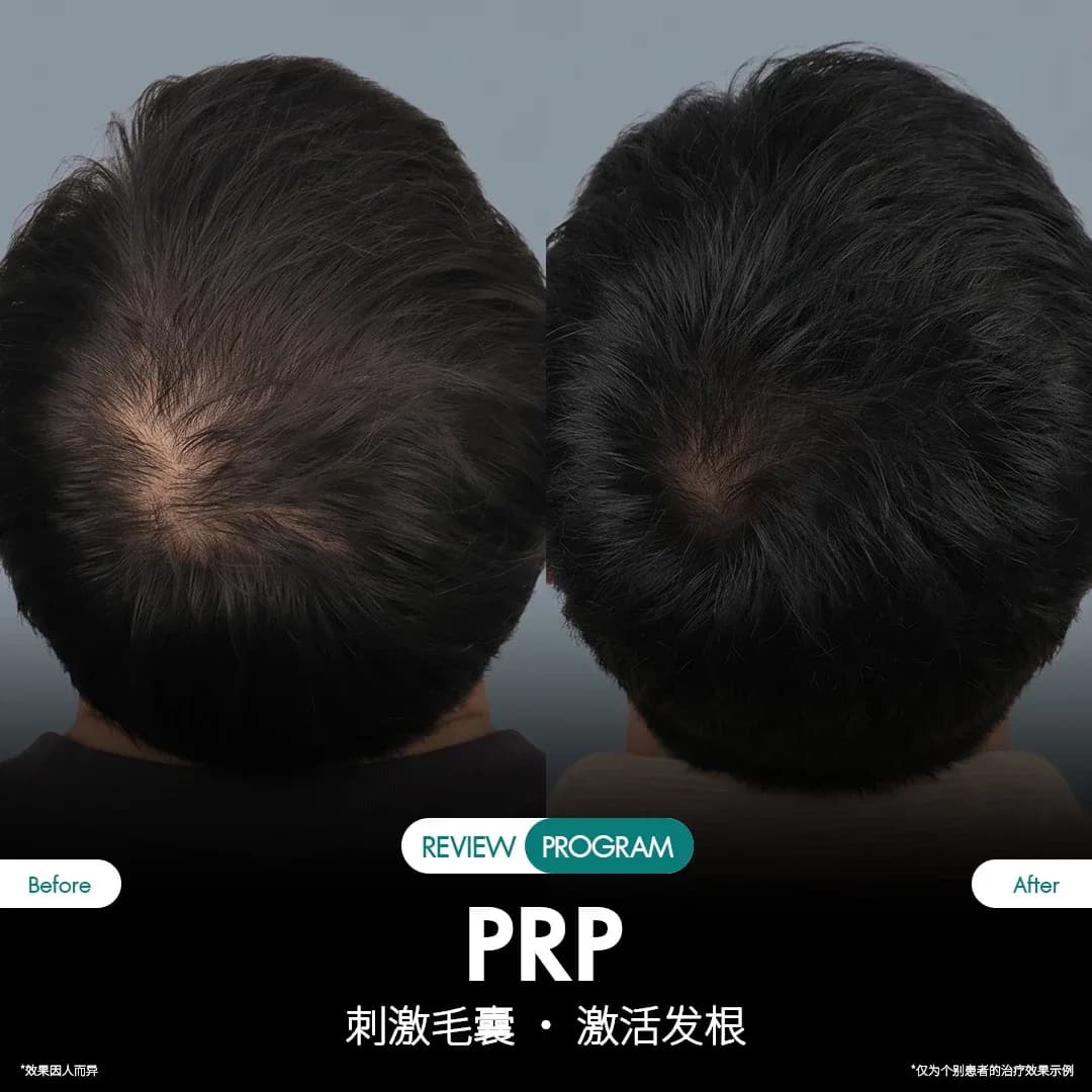 รีวิว ปลูกผม PRP 12