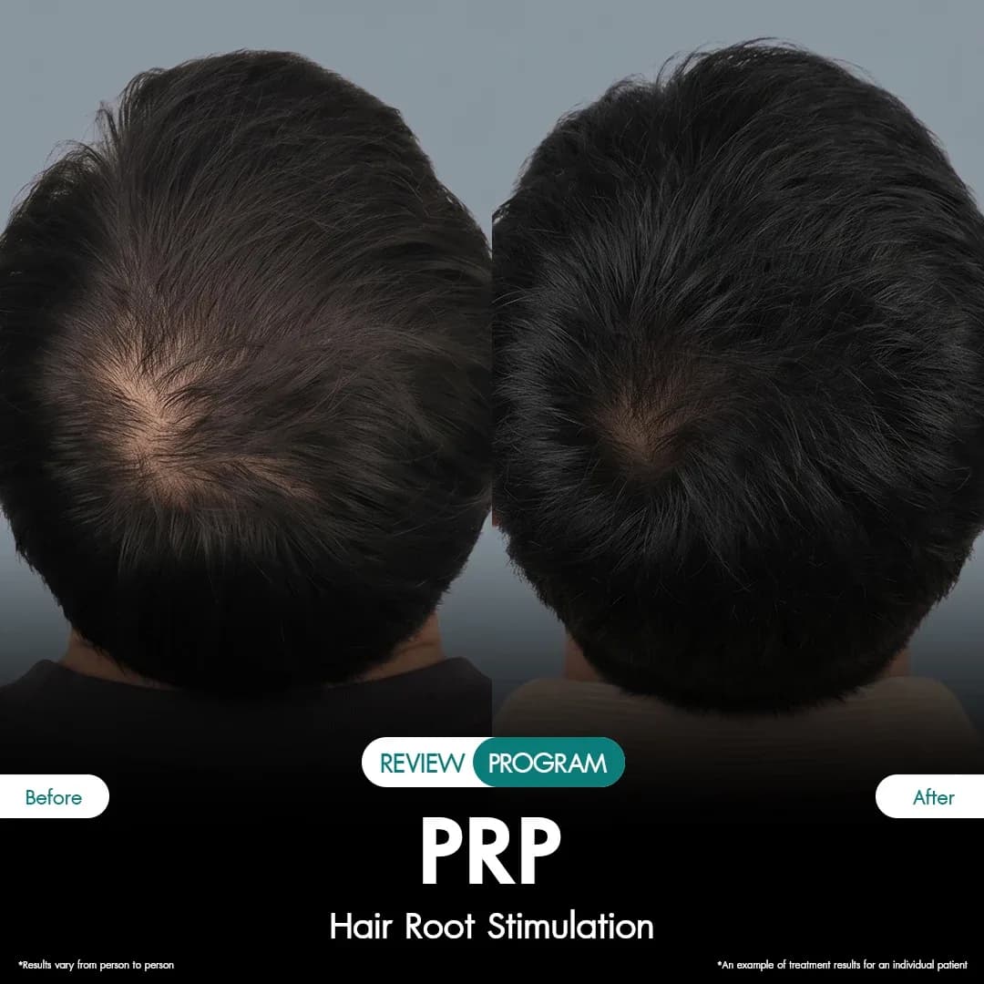รีวิว ปลูกผม PRP 12