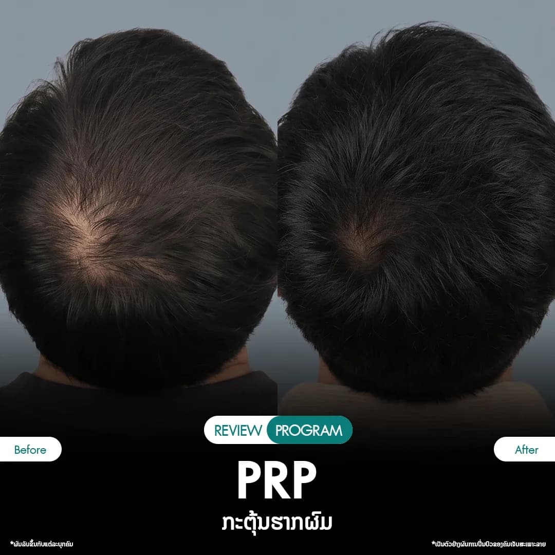 รีวิว ปลูกผม PRP 12