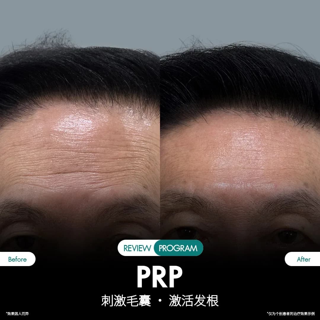 รีวิว ปลูกผม PRP 13